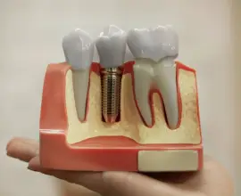 Foto Merită investiția într-un implant dentar?