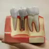 Foto Merită investiția într-un implant dentar?