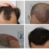 Foto Sprâncenele au nevoie de implant? Încearcă la clinica Dr. Felix Hair Implant pentru rezultate bune!